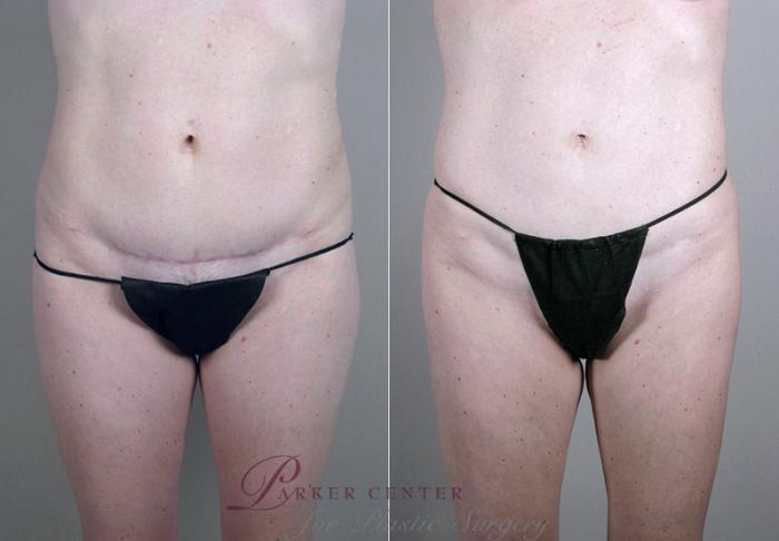 Liposuction Case 384 Before & After View #3 | Paramus, NJ | Parker Center for Plastic Surgery
