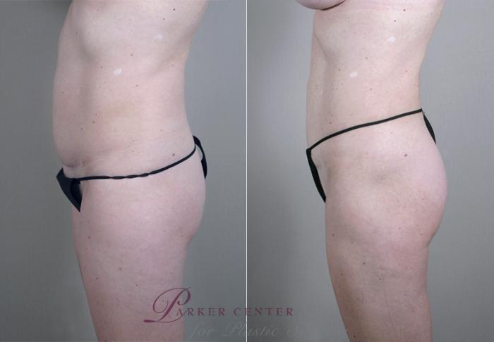 Liposuction Case 384 Before & After View #4 | Paramus, NJ | Parker Center for Plastic Surgery