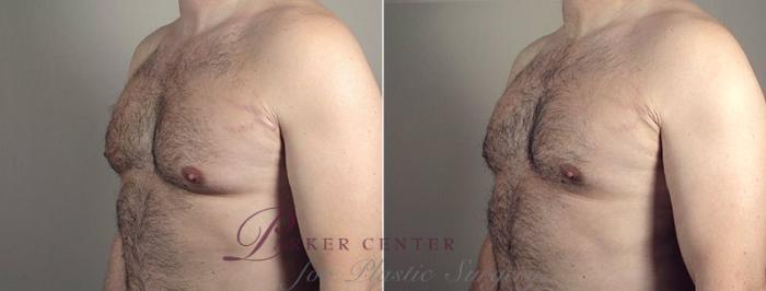 Liposuction Case 669 Before & After View #4 | Paramus, NJ | Parker Center for Plastic Surgery