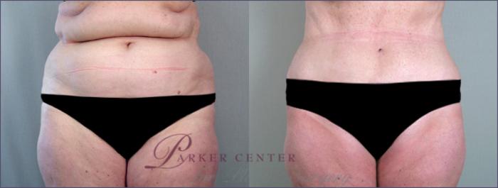 Liposuction Case 685 Before & After View #1 | Paramus, NJ | Parker Center for Plastic Surgery