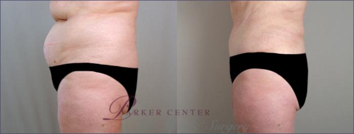 Liposuction Case 685 Before & After View #2 | Paramus, NJ | Parker Center for Plastic Surgery