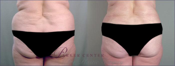 Liposuction Case 685 Before & After View #3 | Paramus, NJ | Parker Center for Plastic Surgery