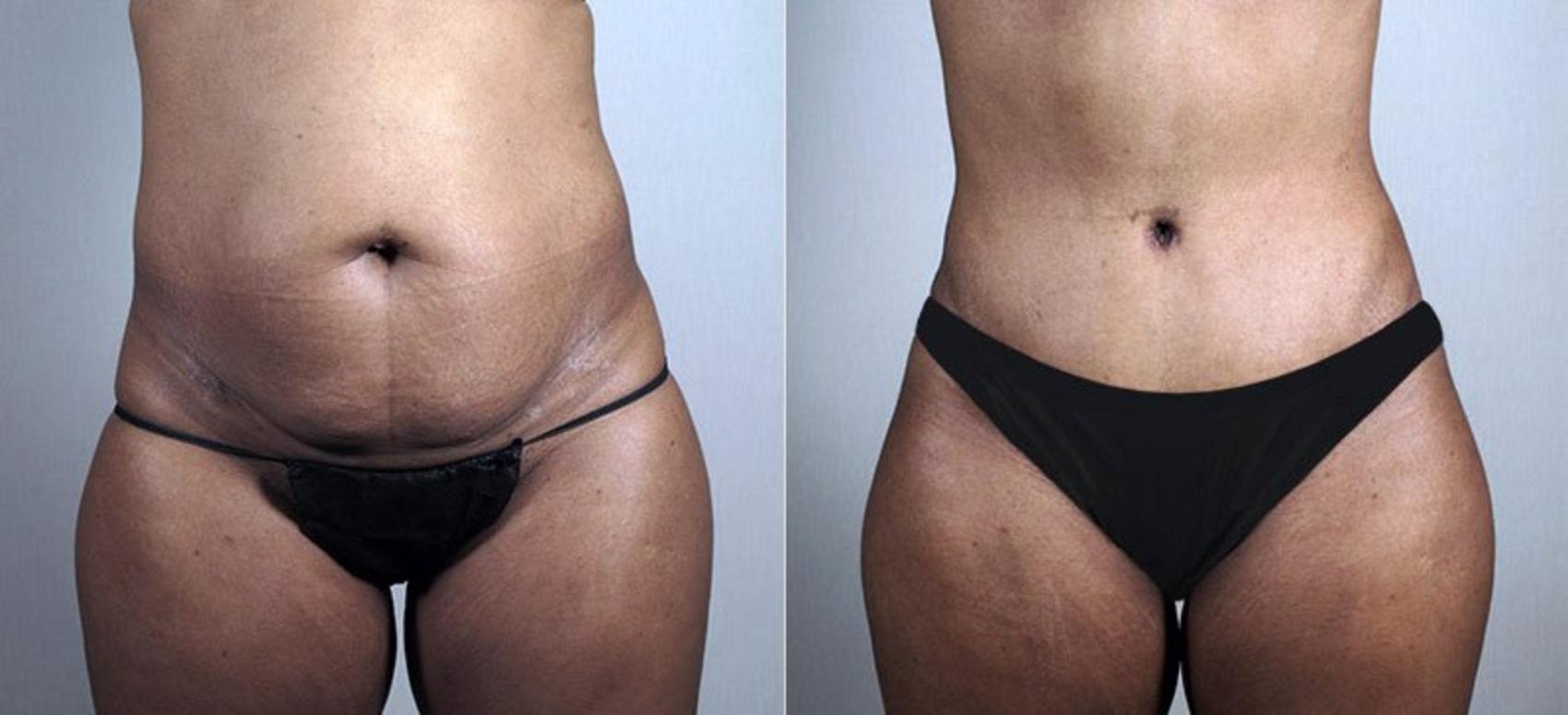 Liposuction Case 730 Before & After View #1 | Paramus, NJ | Parker Center for Plastic Surgery