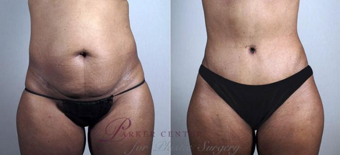 Liposuction Case 730 Before & After View #1 | Paramus, NJ | Parker Center for Plastic Surgery