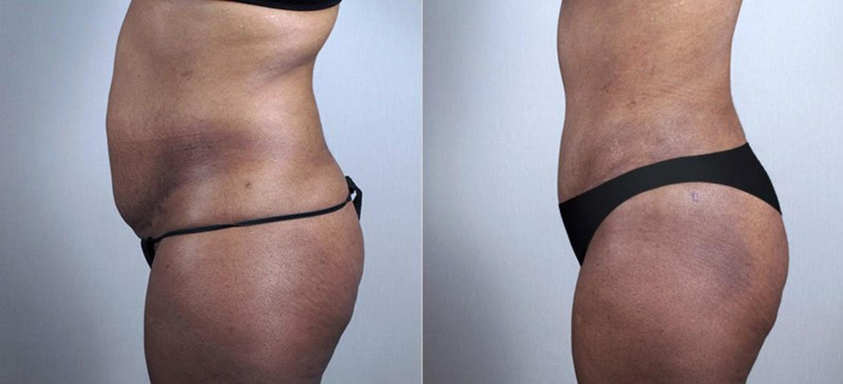 Liposuction Case 730 Before & After View #2 | Paramus, NJ | Parker Center for Plastic Surgery