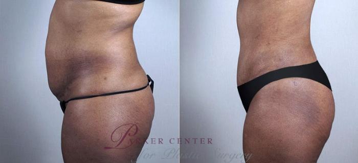 Liposuction Case 730 Before & After View #2 | Paramus, NJ | Parker Center for Plastic Surgery