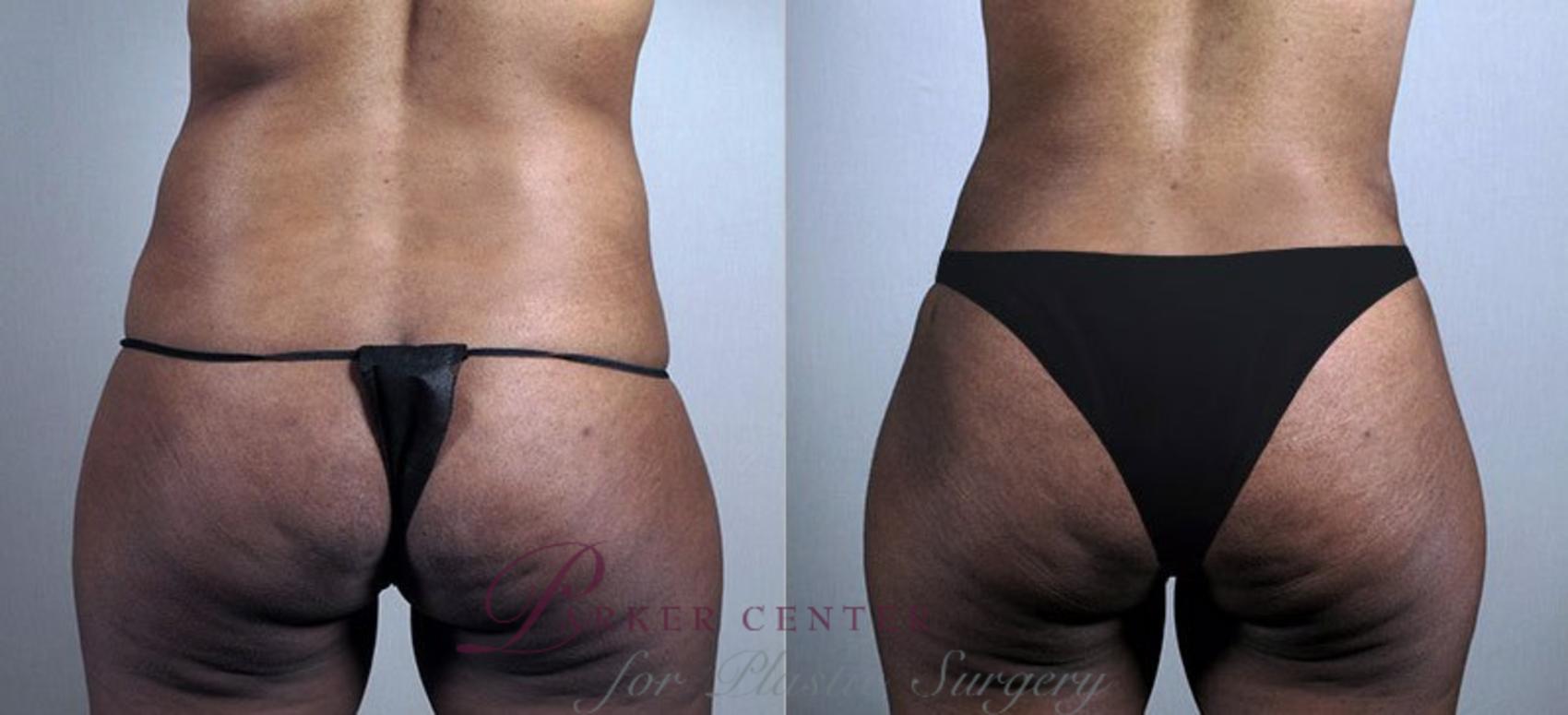 Liposuction Case 730 Before & After View #3 | Paramus, NJ | Parker Center for Plastic Surgery