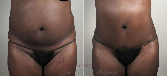 Liposuction Case 735 Before & After View #1 | Paramus, NJ | Parker Center for Plastic Surgery