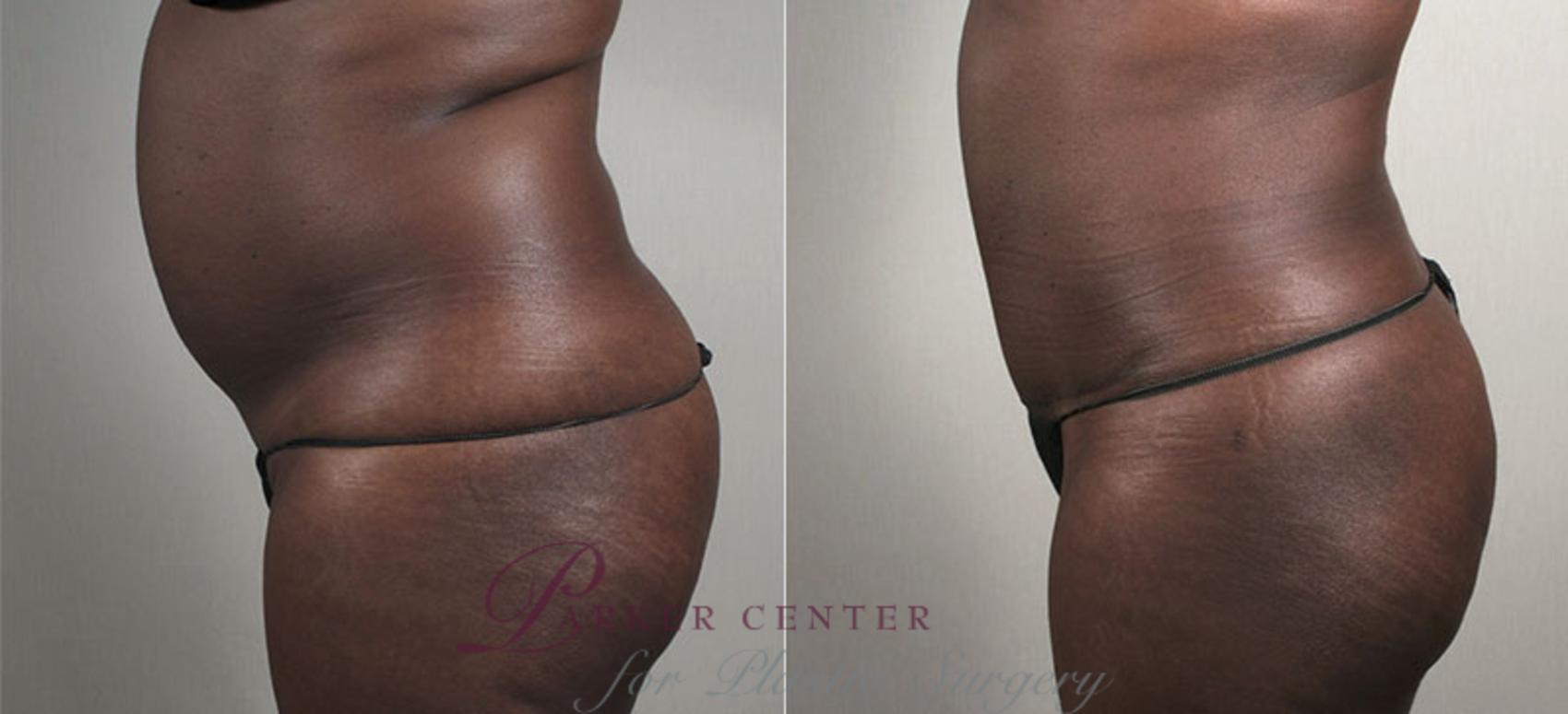 Liposuction Case 735 Before & After View #2 | Paramus, NJ | Parker Center for Plastic Surgery