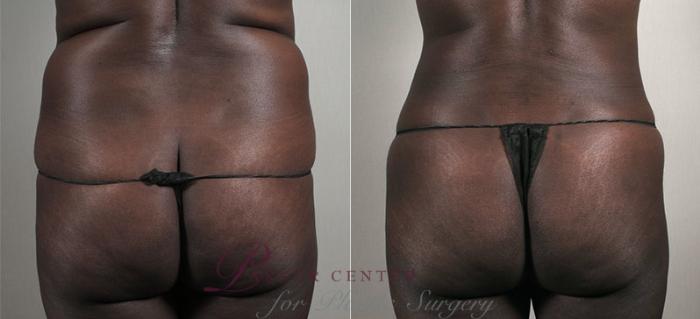 Liposuction Case 735 Before & After View #3 | Paramus, NJ | Parker Center for Plastic Surgery