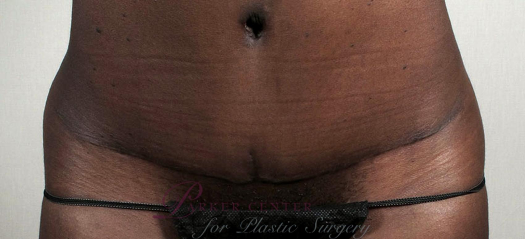 Liposuction Case 735 Before & After View #4 | Paramus, NJ | Parker Center for Plastic Surgery