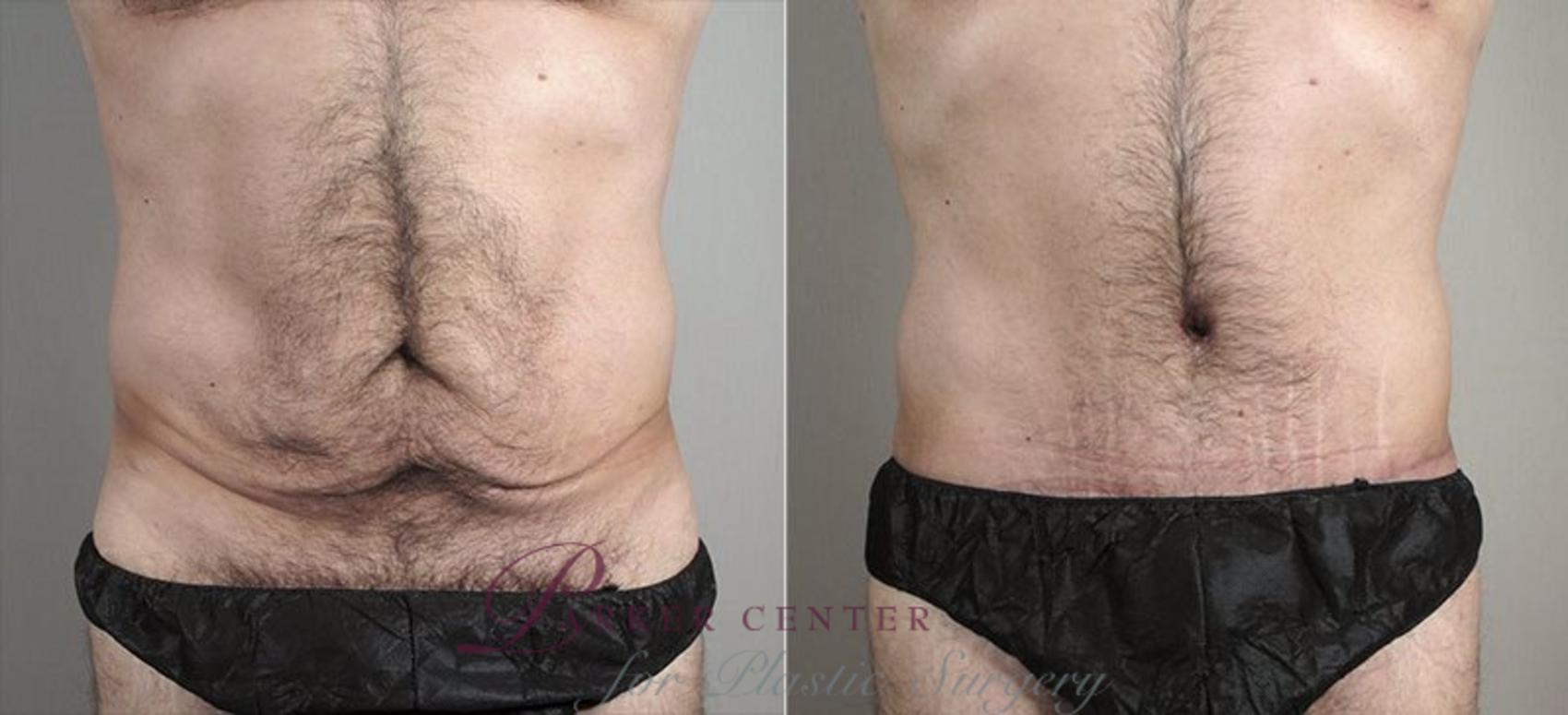Abdominoplasty Case 737 Before & After View #1 | Paramus, NJ | Parker Center for Plastic Surgery