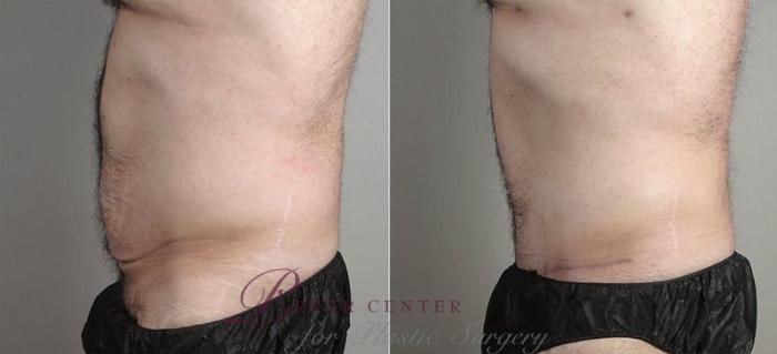 Abdominoplasty and Liposuction to Bilateral Flanks Case #37493 - The  Plastic Surgery Group