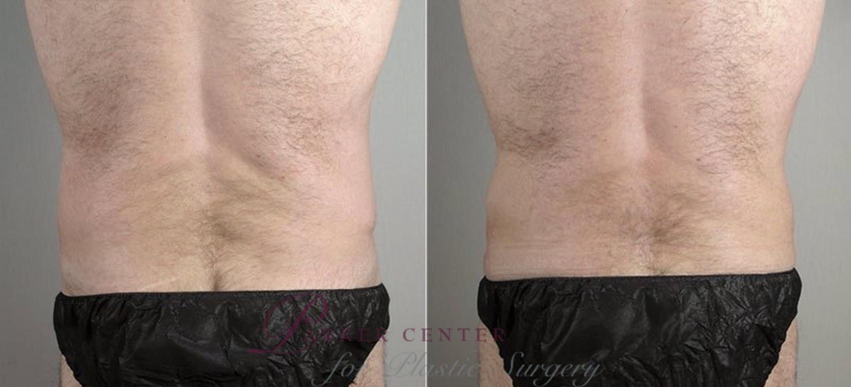 Liposuction Case 737 Before & After View #3 | Paramus, NJ | Parker Center for Plastic Surgery