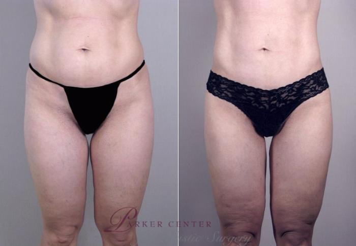 Liposuction Case 756 Before & After View #1 | Paramus, NJ | Parker Center for Plastic Surgery