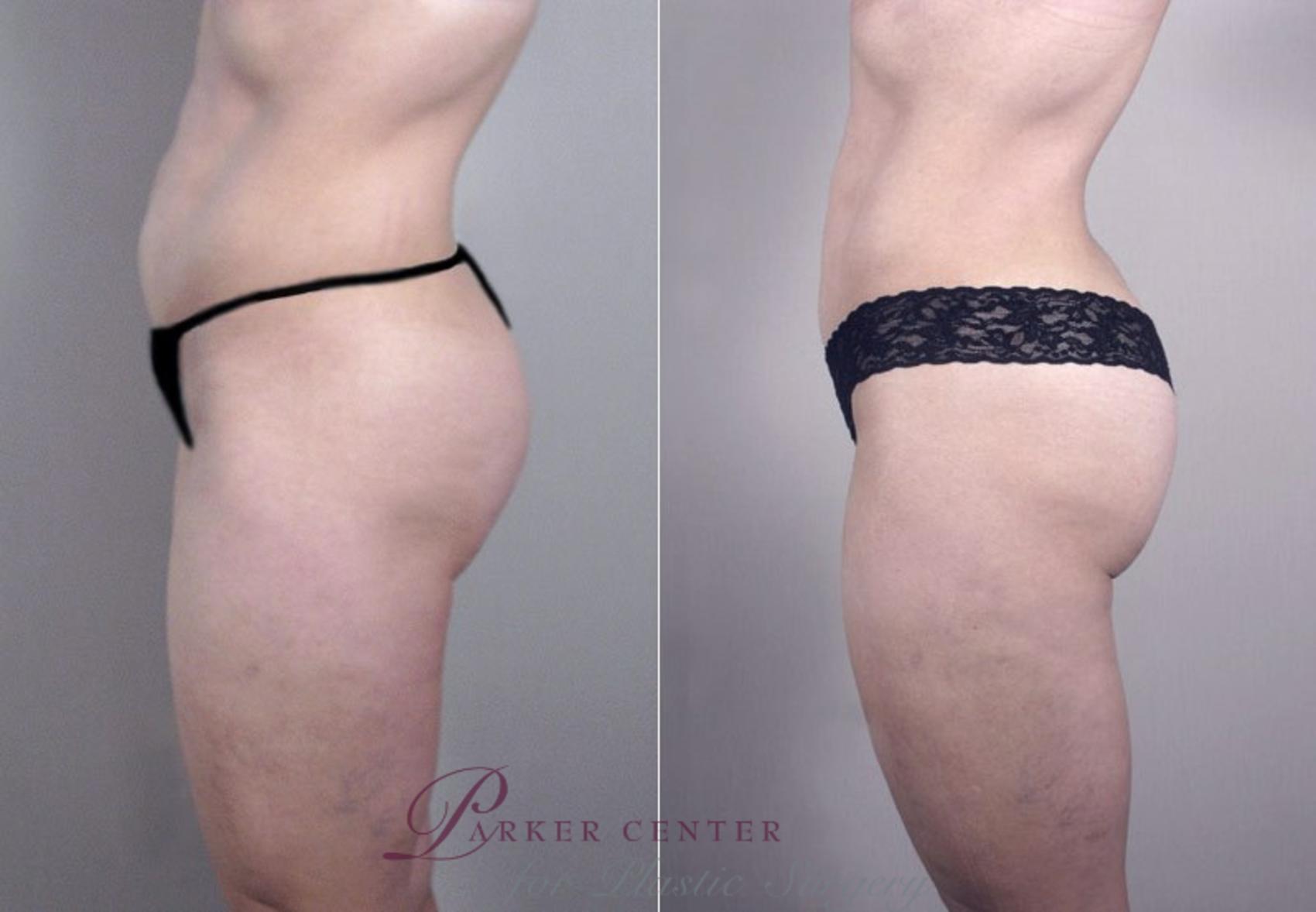 Liposuction Case 756 Before & After View #2 | Paramus, New Jersey | Parker Center for Plastic Surgery