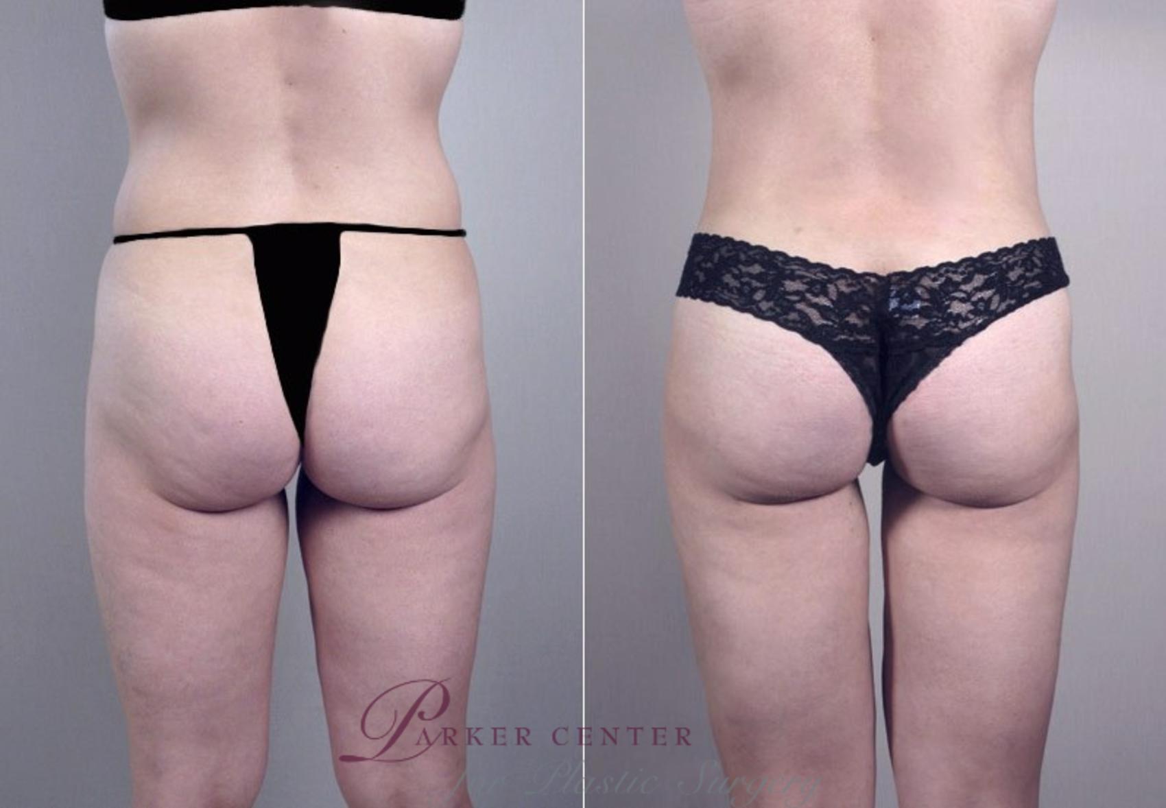 Liposuction Case 756 Before & After View #3 | Paramus, New Jersey | Parker Center for Plastic Surgery