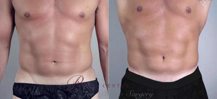 Liposuction Case 758 Before & After View #1 | Paramus, NJ | Parker Center for Plastic Surgery