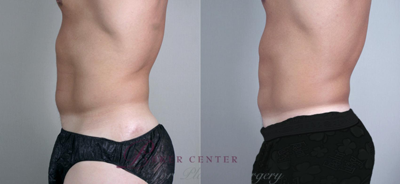 Liposuction Case 758 Before & After View #2 | Paramus, NJ | Parker Center for Plastic Surgery