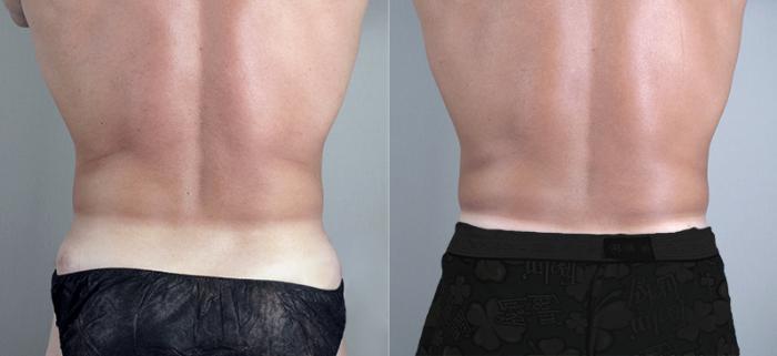 Liposuction of flanks  Care Well Medical Centre