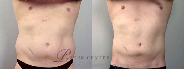 Liposuction Case 759 Before & After View #1 | Paramus, NJ | Parker Center for Plastic Surgery