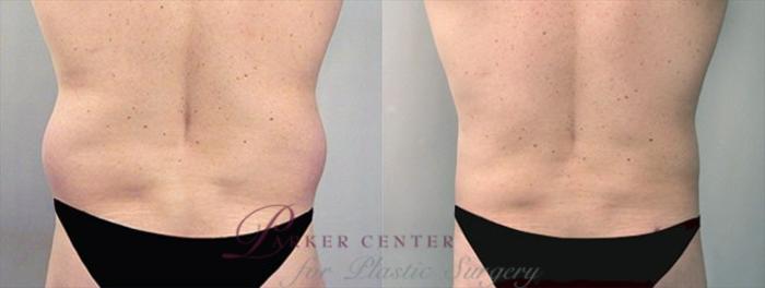 Liposuction Case 759 Before & After View #2 | Paramus, NJ | Parker Center for Plastic Surgery