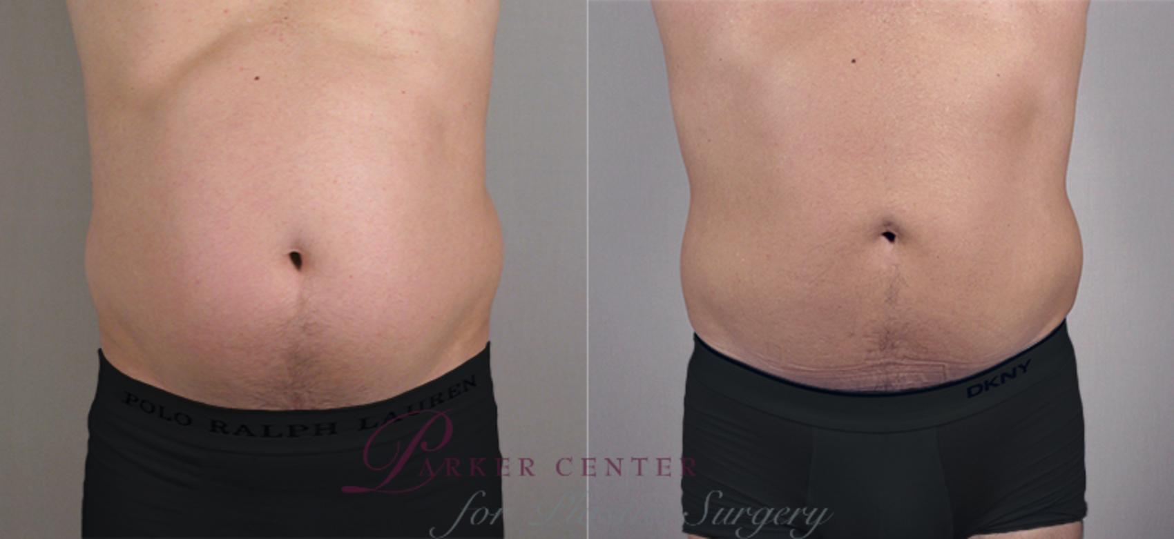Liposuction Case 760 Before & After View #1 | Paramus, NJ | Parker Center for Plastic Surgery