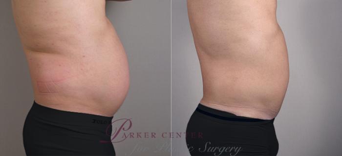 Liposuction Case 760 Before & After View #2 | Paramus, NJ | Parker Center for Plastic Surgery