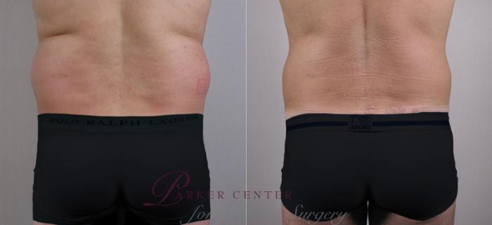 Liposuction Case 760 Before & After View #3 | Paramus, NJ | Parker Center for Plastic Surgery