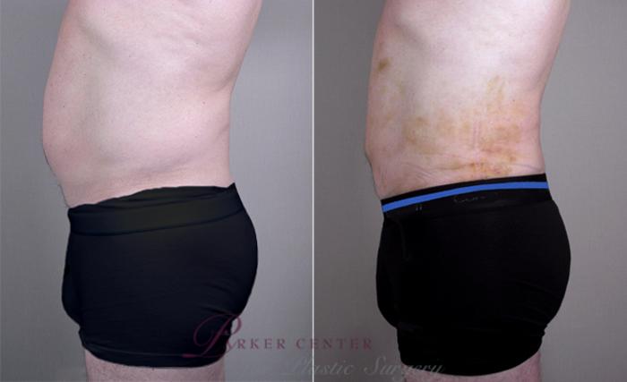 Liposuction Case 761 Before & After View #2 | Paramus, NJ | Parker Center for Plastic Surgery