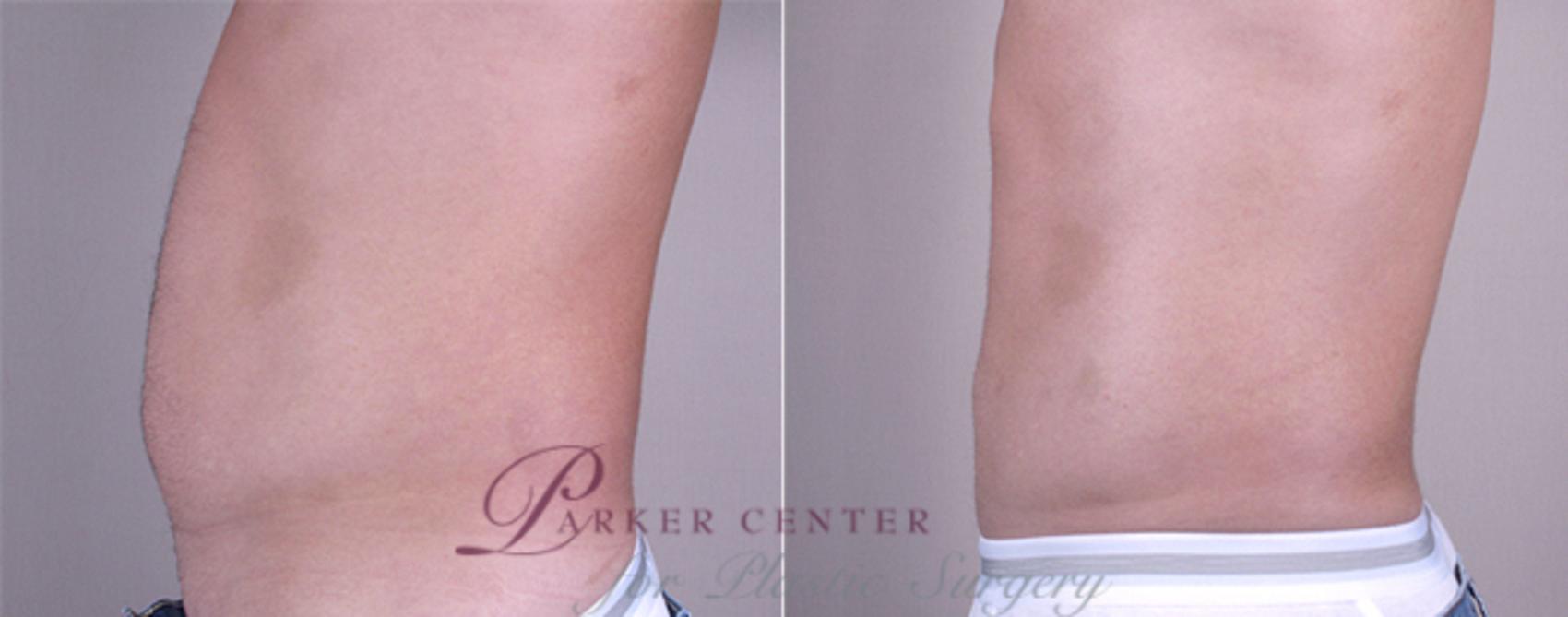 Liposuction Case 762 Before & After View #1 | Paramus, NJ | Parker Center for Plastic Surgery