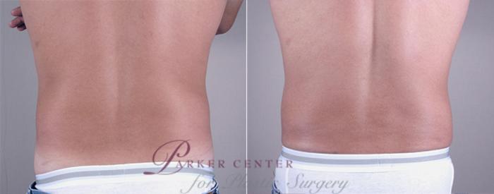 Liposuction Case 762 Before & After View #2 | Paramus, NJ | Parker Center for Plastic Surgery