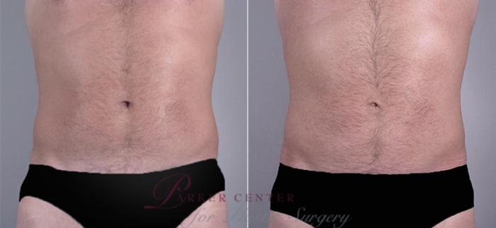 Liposuction Case 763 Before & After View #1 | Paramus, NJ | Parker Center for Plastic Surgery