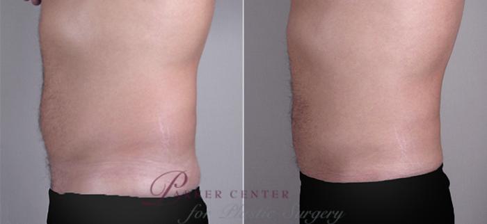 Liposuction Case 763 Before & After View #2 | Paramus, NJ | Parker Center for Plastic Surgery