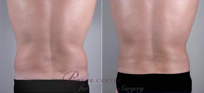 Liposuction Case 763 Before & After View #3 | Paramus, NJ | Parker Center for Plastic Surgery