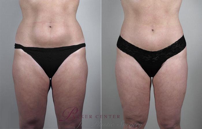 Liposuction Case 764 Before & After View #1 | Paramus, NJ | Parker Center for Plastic Surgery