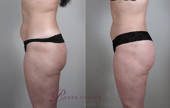 Liposuction Case 764 Before & After View #2 | Paramus, NJ | Parker Center for Plastic Surgery