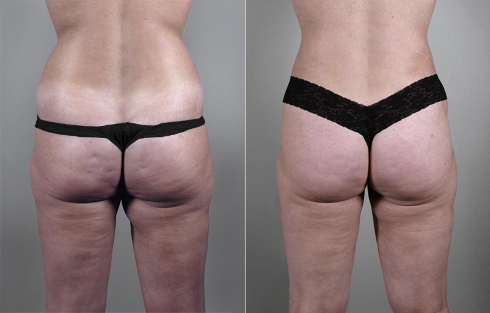 Maria E: FQ111  Liposuction Postsurgical Knee Length Lipo Body