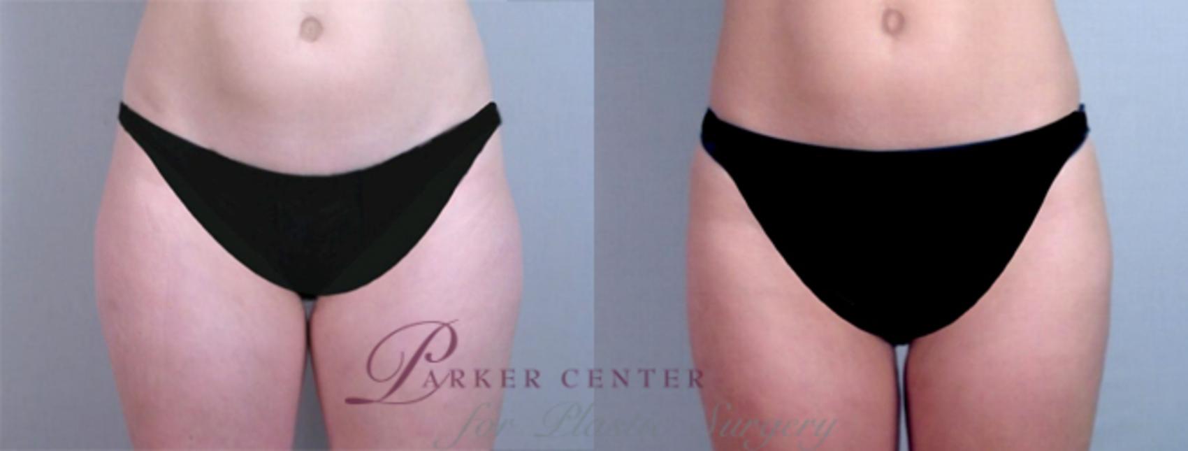 Liposuction Case 765 Before & After View #1 | Paramus, NJ | Parker Center for Plastic Surgery