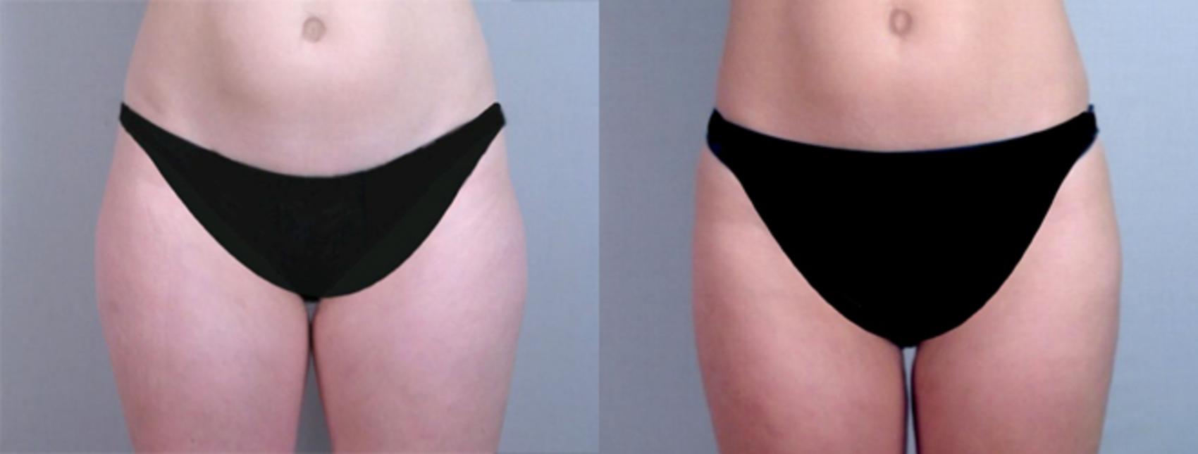 Liposuction Case 765 Before & After View #1 | Paramus, NJ | Parker Center for Plastic Surgery