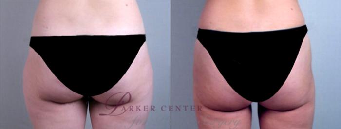 Liposuction Case 765 Before & After View #3 | Paramus, NJ | Parker Center for Plastic Surgery