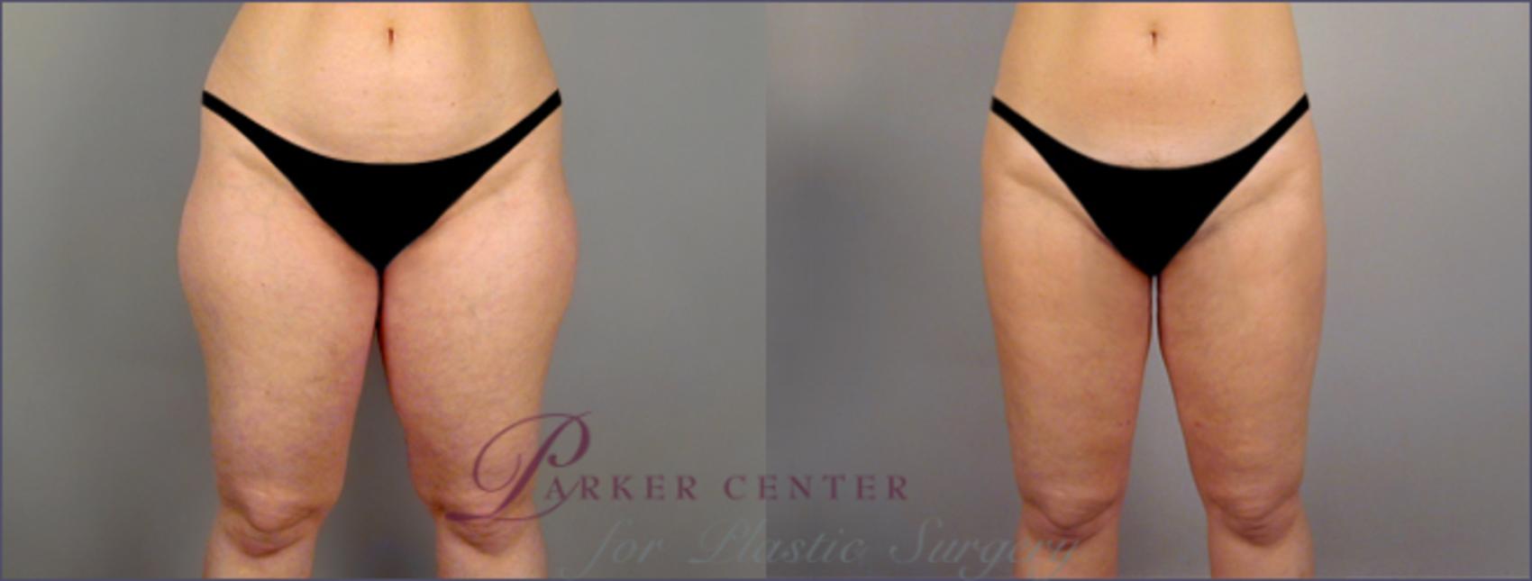 Liposuction Case 766 Before & After View #1 | Paramus, NJ | Parker Center for Plastic Surgery