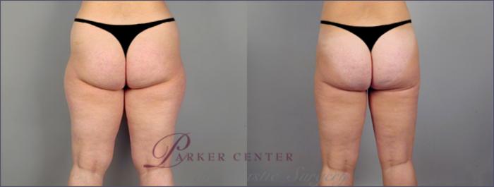 Liposuction Case 766 Before & After View #2 | Paramus, NJ | Parker Center for Plastic Surgery