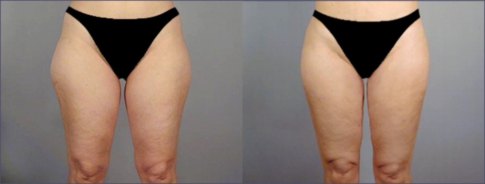 Bra Fat Liposuction with Vaser Lipo Before & After Photos New Jersey -  Reflections Center