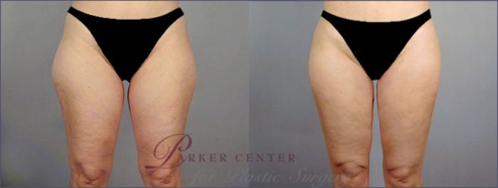 Liposuction Case 767 Before & After View #1 | Paramus, NJ | Parker Center for Plastic Surgery