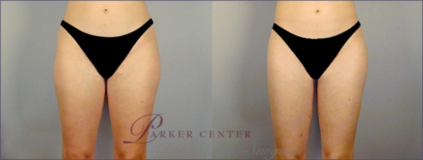 Liposuction Case 768 Before & After View #1 | Paramus, NJ | Parker Center for Plastic Surgery