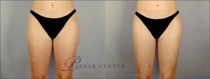 Liposuction Case 768 Before & After View #1 | Paramus, NJ | Parker Center for Plastic Surgery
