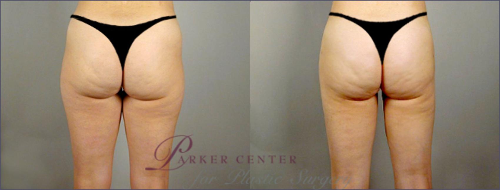 Liposuction Case 768 Before & After View #2 | Paramus, NJ | Parker Center for Plastic Surgery