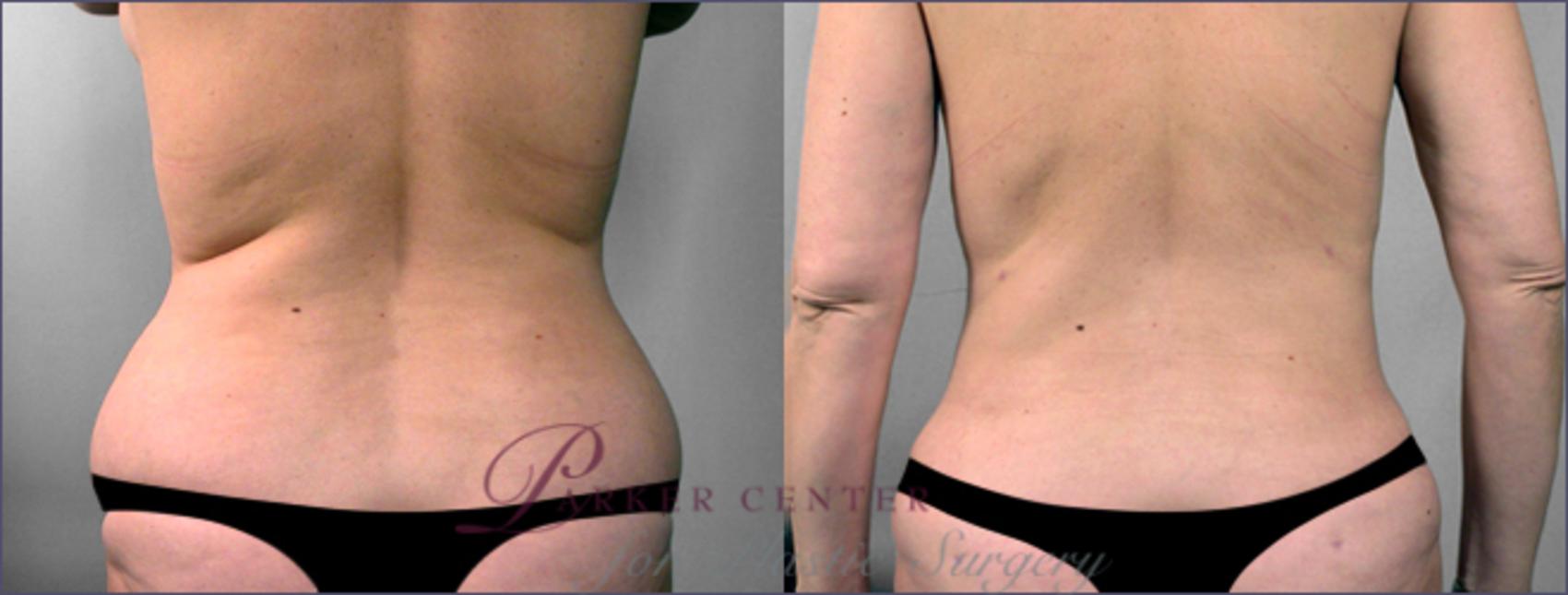 Liposuction Before and After Pictures Case 769, Paramus, NJ