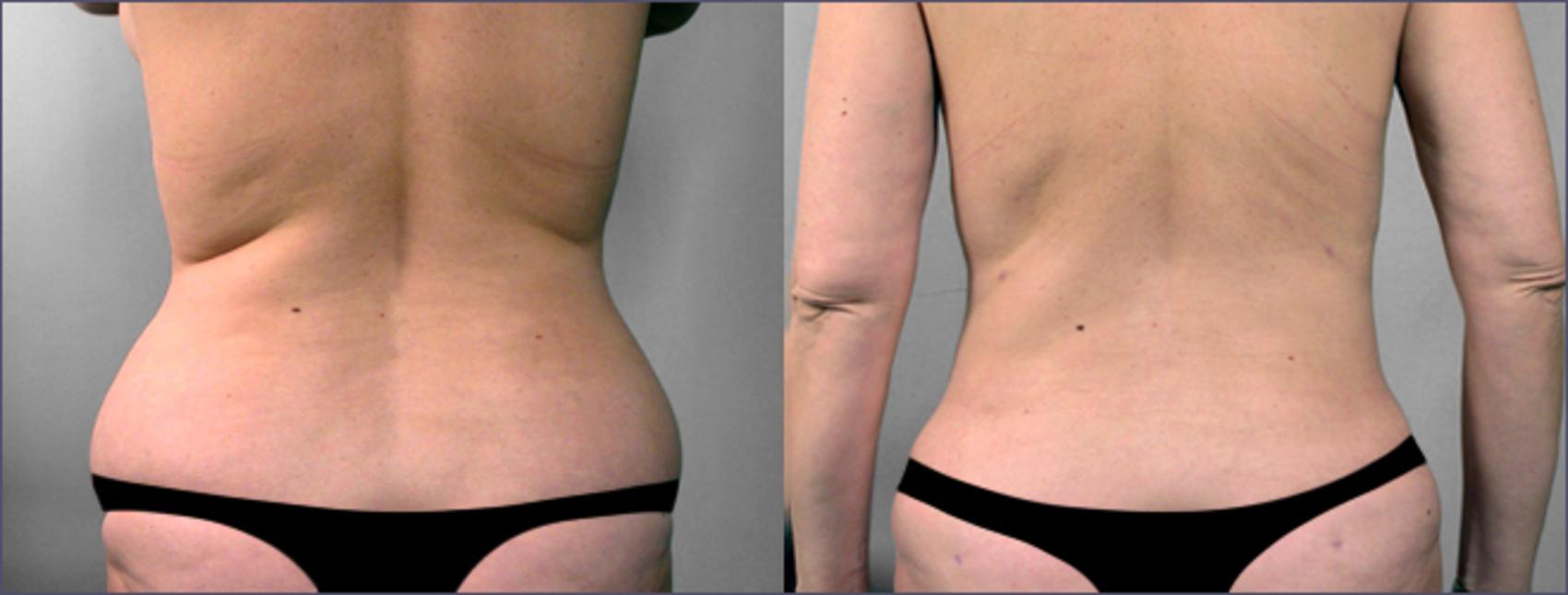 Liposuction Before and After Pictures Case 769